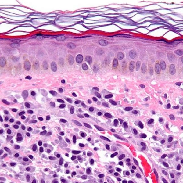 Lirentelimab u indolentní systémové mastocytózy